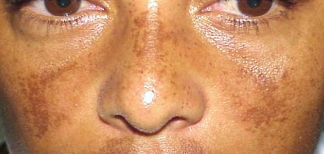 أسباب سواد الوجه صورة مقال أسباب سواد الوجه