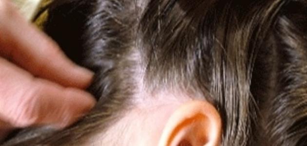 أسباب ظهور القمل والصيبان صورة مقال أسباب ظهور القمل والصيبان