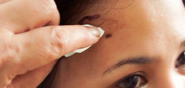 إزالة الصبغة من الجلد صورة مقال إزالة الصبغة من الجلد