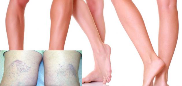 تمارين لعلاج تقوس الساقين صورة مقال تمارين لعلاج تقوس الساقين