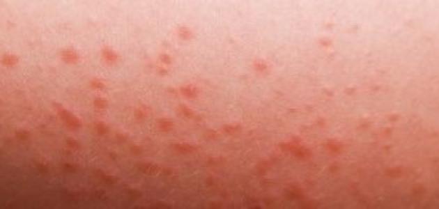 ما هي شرية البرد صورة مقال ما هي شرية البرد