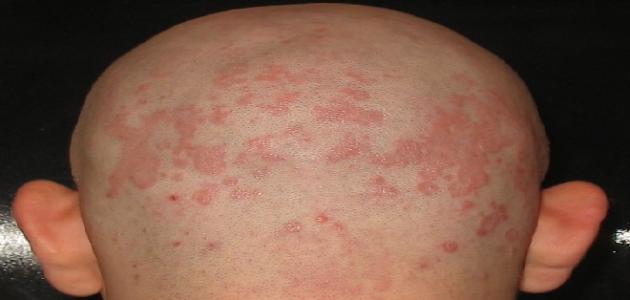 فطريات الرأس و علاجها صورة مقال فطريات الرأس و علاجها