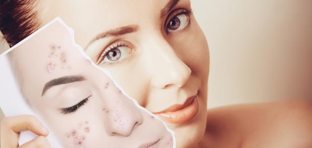 طريقة إزالة آثار الحبوب صورة مقال طريقة إزالة آثار الحبوب