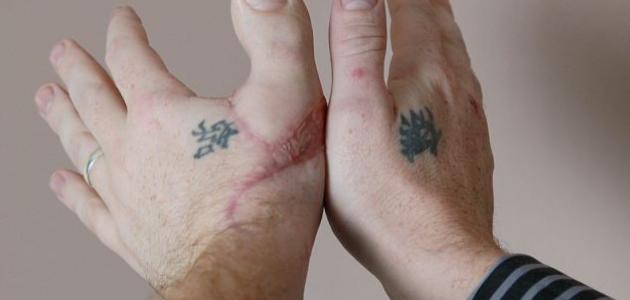 إلتهاب وتر الإبهام صورة مقال إلتهاب وتر الإبهام