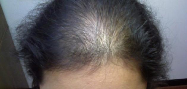 كسل الغدة الدرقية و أعراضه صورة مقال كسل الغدة الدرقية و أعراضه