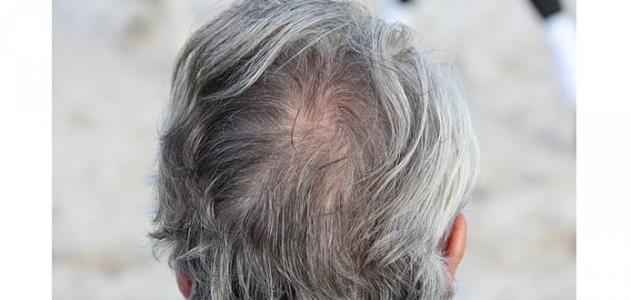 الشعر الأبيض صورة مقال الشعر الأبيض