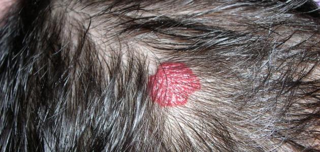 فطريات الشعر صورة مقال فطريات الشعر