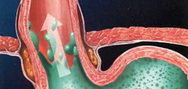 الارتجاع المريئي و فتق الحجاب الحاجز صورة مقال الارتجاع المريئي و فتق الحجاب الحاجز