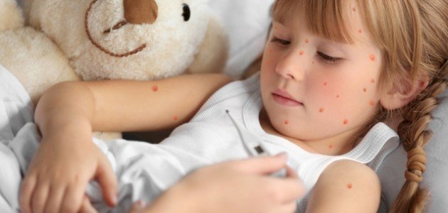 مرض الجدري صورة مقال مرض الجدري