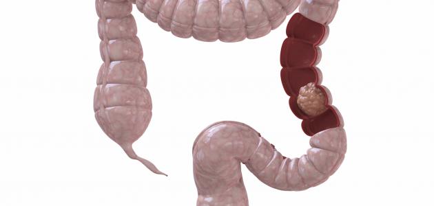 سرطان القولون والمستقيم صورة مقال سرطان القولون والمستقيم