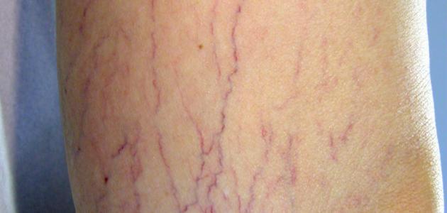 ما هي مضاعفات مرض دوالي الساقين صورة مقال ما هي مضاعفات مرض دوالي الساقين